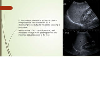 Interpostal Scanning Abdominal_Ultrasound__Liver (1).pptx understand | PPTX