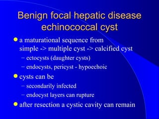 Benign focal hepatic disease echinococcal cyst <ul><li>a maturational sequence from simple -> multiple cyst -> calcified c...