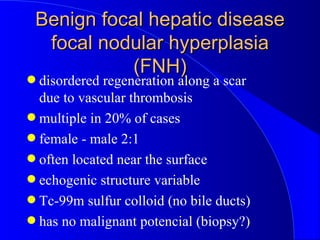 Benign focal hepatic disease focal nodular hyperplasia (FNH) <ul><li>disordered regeneration along a scar due to vascular ...