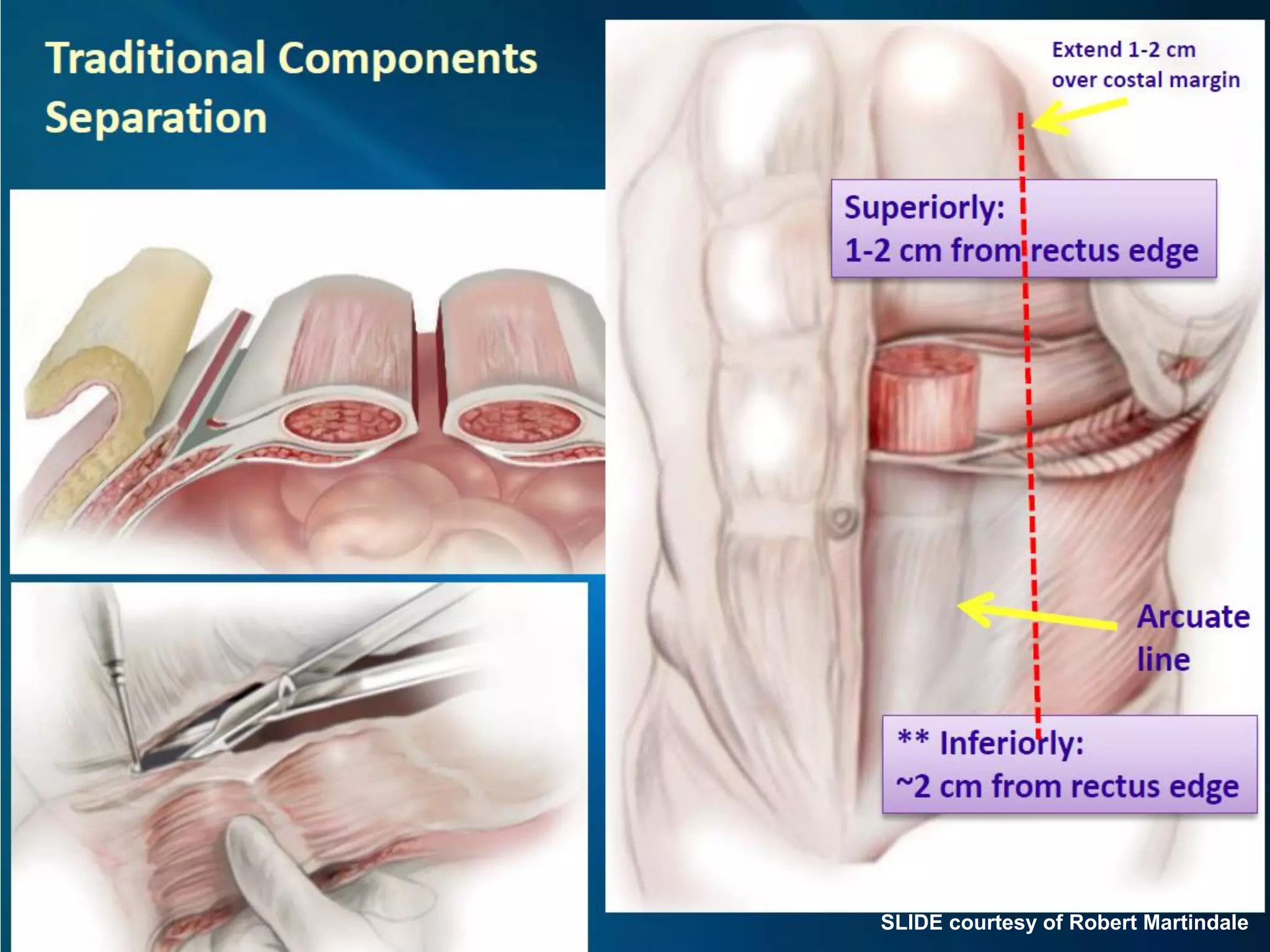 Abdominal wall anatomy with respect to understanding component ...