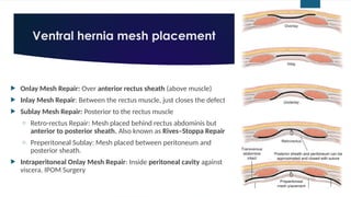 Sublay Only Comprehensive Abdominal Wall Anatomy for Hernia Repair Surgery | PPTX