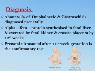 abdominal wall defect in child health nursing | PPTX