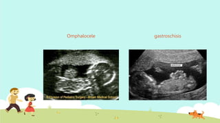 Omphalocele gastroschisis
 