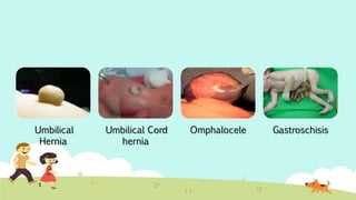 Umbilical
Hernia
Umbilical Cord
hernia
Omphalocele Gastroschisis
 