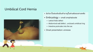 Umbilical Cord Hernia
 มีอวัยวะในช่องท้องยื่นเข้ามาอยู่ในส่วนต้นของสายสะดือ
 Embryology = small omphalocele
 Lateral folds defect
 Abdominal wall defect , unclosed umbilical ring
 Intestine protrudes into the sac
 Onset presentation: แรกคลอด
 