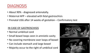 Abdominal wall defects (dr.tanvir) | PPTX