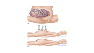Abdominal wall defects (dr.tanvir) | PPTX