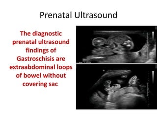 Prenatal Ultrasound
The diagnostic
prenatal ultrasound
findings of
Gastroschisis are
extraabdominal loops
of bowel without
covering sac
 