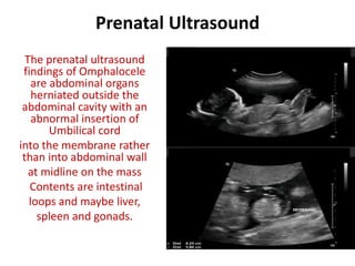 Prenatal Ultrasound
The prenatal ultrasound
findings of Omphalocele
are abdominal organs
herniated outside the
abdominal cavity with an
abnormal insertion of
Umbilical cord
into the membrane rather
than into abdominal wall
at midline on the mass
Contents are intestinal
loops and maybe liver,
spleen and gonads.
 