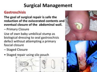 Surgical Management
Gastroschisis
The goal of surgical repair is safe the
reduction of the eviscerated contents and
eventual closure of the abdominal wall.
– Primary Closure
Use of own baby umbilical stump as
biological dressing to seal gastroschisis
defect without attempting a primary
fascial closure
– Staged Closure
• Staged repair using silo pouch
 
