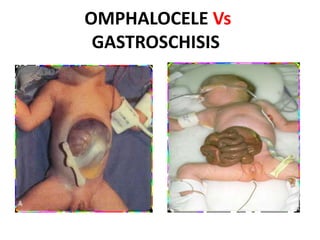 OMPHALOCELE Vs
GASTROSCHISIS
 