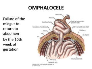 OMPHALOCELE
Failure of the
midgut to
return to
abdomen
by the 10th
week of
gestation
 