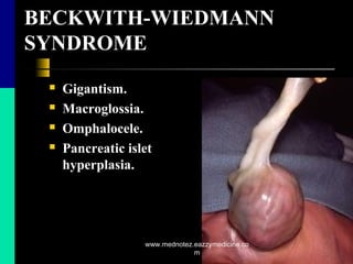 BECKWITH-WIEDMANN
SYNDROME
 Gigantism.
 Macroglossia.
 Omphalocele.
 Pancreatic islet
hyperplasia.
www.mednotez.eazzymedicine.co
m
 