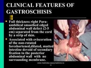 CLINICAL FEATURES OF
GASTROSCHISIS
 Full thickness right Para-
umbilical smoothed edged
abdominal wall defect (2-5
cm) separated from the cord
by a strip of skin.
 Associated with evisceration
of the non-rotated
foreshortened,dilated, matted
intestine devoid of secondary
fixation to the posterior
abdominal wall with no
surrounding membrane.
www.mednotez.eazzymedicine.co
m
 