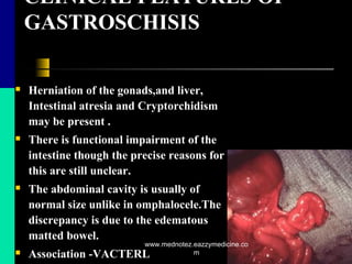 CLINICAL FEATURES OF
GASTROSCHISIS
 Herniation of the gonads,and liver,
Intestinal atresia and Cryptorchidism
may be present .
 There is functional impairment of the
intestine though the precise reasons for
this are still unclear.
 The abdominal cavity is usually of
normal size unlike in omphalocele.The
discrepancy is due to the edematous
matted bowel.
 Association -VACTERL
www.mednotez.eazzymedicine.co
m
 