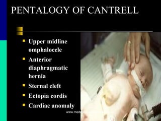 PENTALOGY OF CANTRELL
 Upper midline
omphalocele
 Anterior
diaphragmatic
hernia
 Sternal cleft
 Ectopia cordis
 Cardiac anomaly
www.mednotez.eazzymedicine.co
m
 