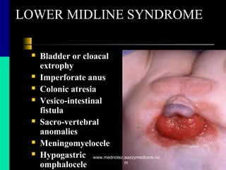 LOWER MIDLINE SYNDROME
 Bladder or cloacal
extrophy
 Imperforate anus
 Colonic atresia
 Vesico-intestinal
fistula
 Sacro-vertebral
anomalies
 Meningomyelocele
 Hypogastric
omphalocele
www.mednotez.eazzymedicine.co
m
 