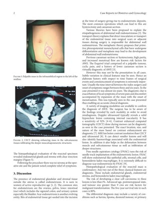 2 Case Reports in Obstetrics and Gynecology
Figure 1: Palpable mass in the infraumbilical region to the left of the
midlin...
