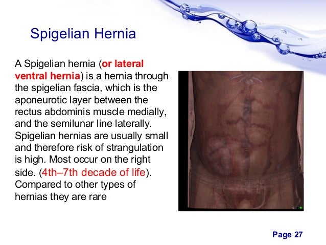Abdominal Wall Hernia Abdominal Wall Hernia