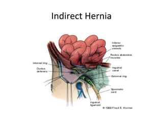 Indirect Hernia
 