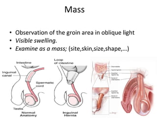 • Observation of the groin area in oblique light
• Visible swelling.
• Examine as a mass; (site,skin,size,shape,…)
Mass
 