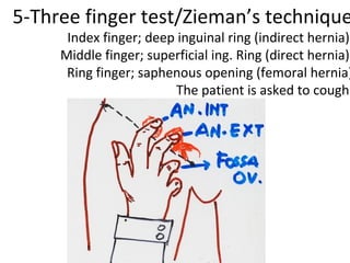 5-Three finger test/Zieman’s technique
Index finger; deep inguinal ring (indirect hernia)
Middle finger; superficial ing. Ring (direct hernia)
Ring finger; saphenous opening (femoral hernia)
The patient is asked to cough.
 