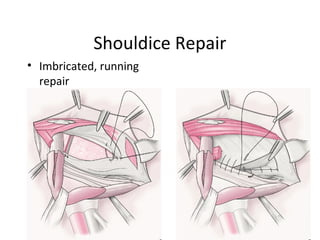 Shouldice Repair
• Imbricated, running
repair
 