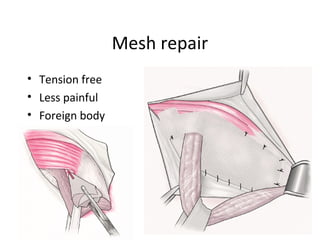 Mesh repair
• Tension free
• Less painful
• Foreign body
 