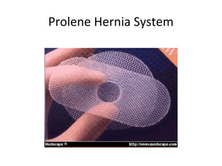 Prolene Hernia System
 