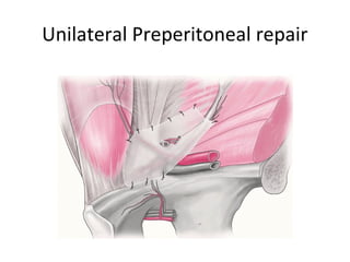 Unilateral Preperitoneal repair
 