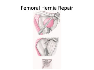 Femoral Hernia Repair
 