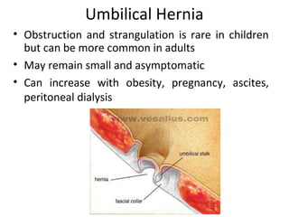 Umbilical Hernia
• Obstruction and strangulation is rare in children
but can be more common in adults
• May remain small and asymptomatic
• Can increase with obesity, pregnancy, ascites,
peritoneal dialysis
 