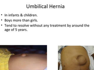 Umbilical Hernia
• In infants & children.
• Boys more than girls.
• Tend to resolve without any treatment by around the
age of 5 years.
 