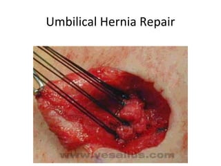 Umbilical Hernia Repair
 