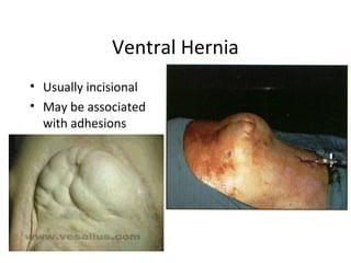 Ventral Hernia
• Usually incisional
• May be associated
with adhesions
 