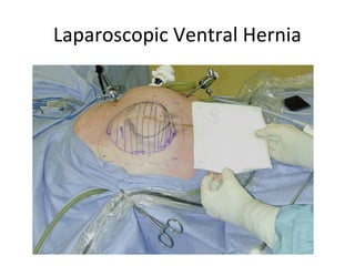 Laparoscopic Ventral Hernia
 