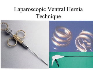 Laparoscopic Ventral Hernia
Technique
 