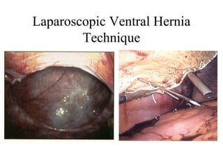 Laparoscopic Ventral Hernia
Technique
 