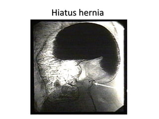 Hiatus hernia
Hiatus hernia
Greater curve
of stomach
Pylorus
 