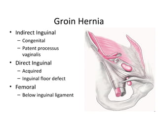 Groin Hernia
• Indirect Inguinal
– Congenital
– Patent processus
vaginalis
• Direct Inguinal
– Acquired
– Inguinal floor defect
• Femoral
– Below inguinal ligament
 