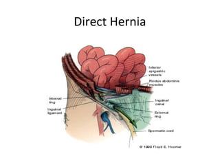 Direct Hernia
 