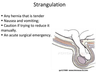 • Any hernia that is tender
• Nausea and vomiting;
• Caution if trying to reduce it
manually.
• An acute surgical emergency.
Strangulation
 