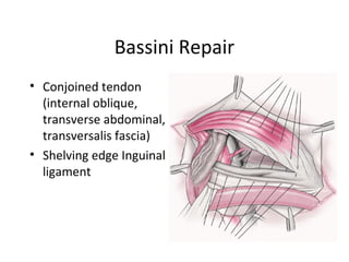 Bassini Repair
• Conjoined tendon
(internal oblique,
transverse abdominal,
transversalis fascia)
• Shelving edge Inguinal
ligament
 