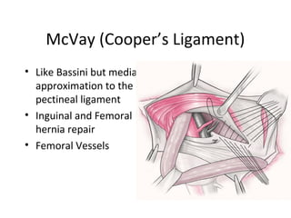 McVay (Cooper’s Ligament)
• Like Bassini but medial
approximation to the
pectineal ligament
• Inguinal and Femoral
hernia repair
• Femoral Vessels
 