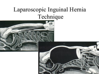 Laparoscopic Inguinal Hernia
Technique
 