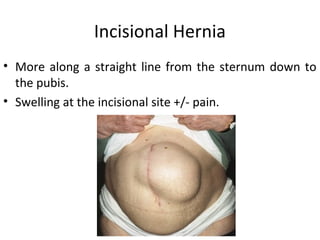 Incisional Hernia
• More along a straight line from the sternum down to
the pubis.
• Swelling at the incisional site +/- pain.
 