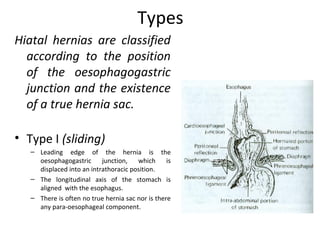 Types
Hiatal hernias are classified
according to the position
of the oesophagogastric
junction and the existence
of a true hernia sac.
• Type I (sliding)
– Leading edge of the hernia is the
oesophagogastric junction, which is
displaced into an intrathoracic position.
– The longitudinal axis of the stomach is
aligned with the esophagus.
– There is often no true hernia sac nor is there
any para-oesophageal component.
 