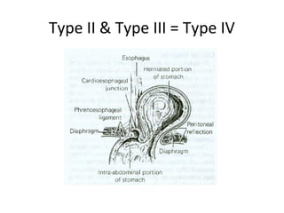 Type II & Type III = Type IV
 