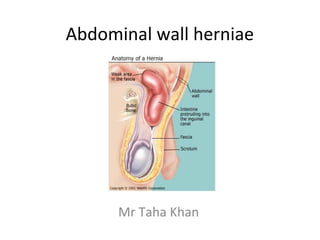 Abdominal wall herniae
Mr Taha Khan
 