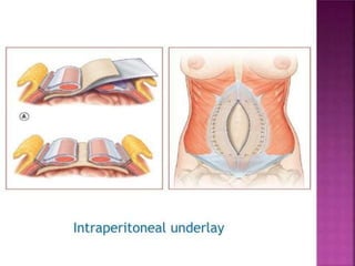 abdominal wall reconstruction الجاهز.pptx